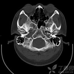 正常鼻骨ct图片